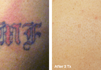 Arms - Before and after Tattoo Removal in Austin, TX
