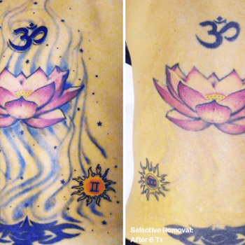 Before and after Tattoo Removal in Austin, TX