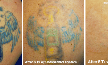 Angel Tattoo Picture - Before and after Tattoo Removal in Austin, TX