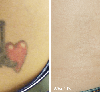 Picture of Heart - Before and after Tattoo Removal in Austin, TX