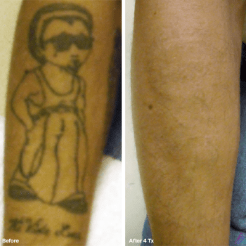 Cartoon Illustration - Before and after Tattoo Removal in Austin, TX