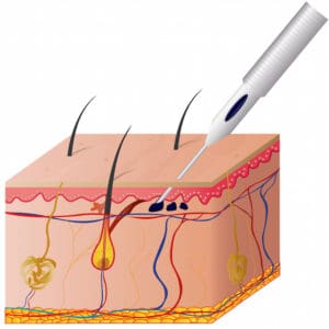 Austin Laser Tattoo Removal on the Epidermis of Your Skin