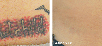 Removing a Tatoo - Before and after Tattoo Removal in Austin, TX