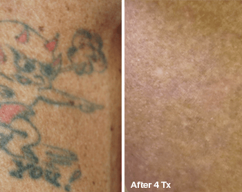 Removing an unwanted Tatoo - Before and after Tattoo Removal in Austin, TX