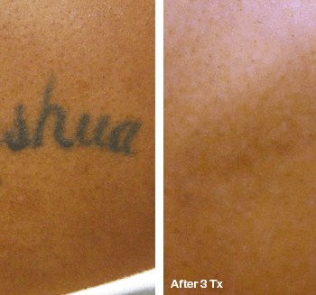 Removing a name Tattoo - Before and after Tattoo Removal in Austin, TX