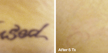 Removing a Tattoo in Austin - Before and after