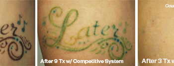 Removing a Complex Tattoo in Austin - Before and after