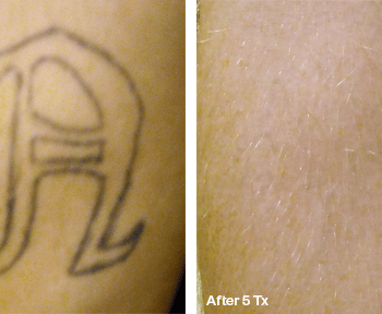 Removing a Lettered Tattoo in Austin - Before and after