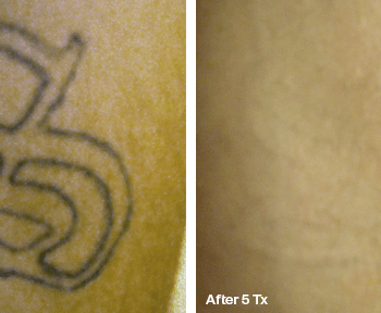 Removing a Letter Tattoo in Austin - Before and after