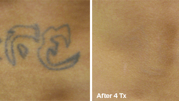 Removing a Faded Tattoo in Austin - Before and after