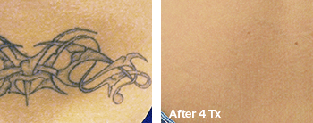 Removing a Shaded Tattoo in Austin - Before and after