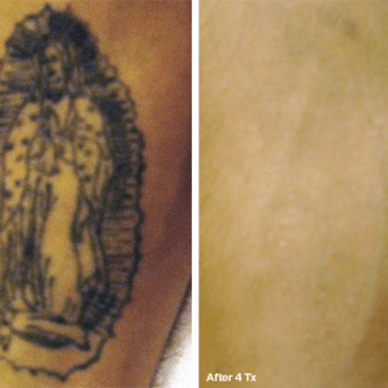 Removing a Religious Tattoo in Austin - Before and after