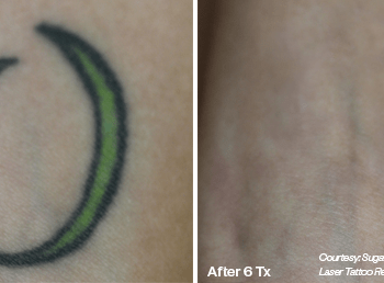 Removing a Moon shaped Tattoo in Austin - Before and after