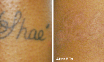 Best before after picture of person's name - Tattoo Removal in Austin
