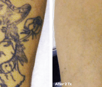 Best before after picture of Girlfriend - Tattoo Removal in Austin