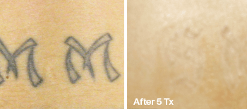 Best before after picture of Tattoo Removal in Austin