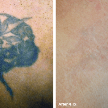 Best before after picture of Skull - Tattoo Removal in Austin