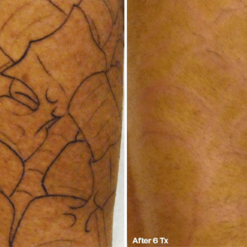 Removing a Spider Web Tattoo in Austin - Before and after