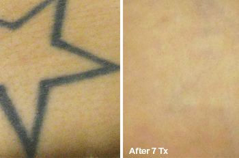 Removing a Star Tattoo in Austin - Before and after