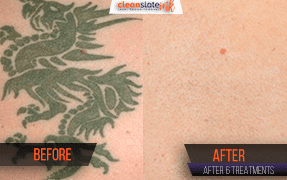Are UV Tattoos worth the Risk? - Austin Tattoo Removal - Clean Slate Ink