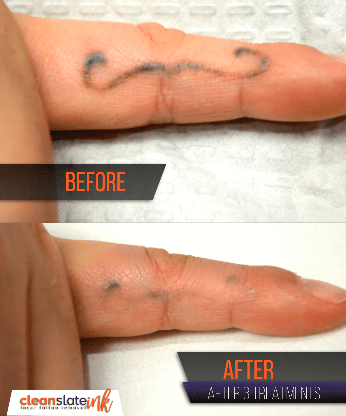 Before & After Results - Austin Tattoo Removal - Clean Slate Ink